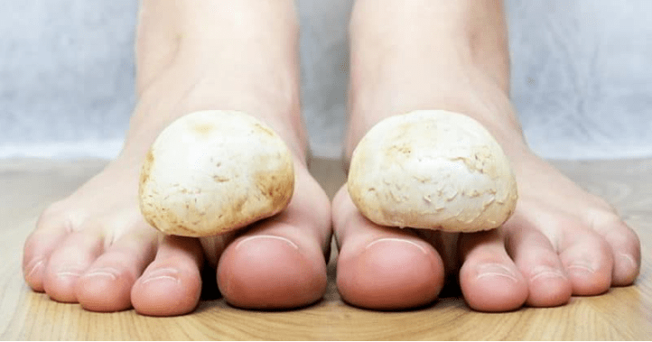 Traitement rapide des champignons sur les jambes de la maison