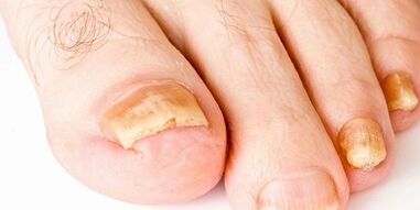 Comment et comment traiter le champignon des ongles