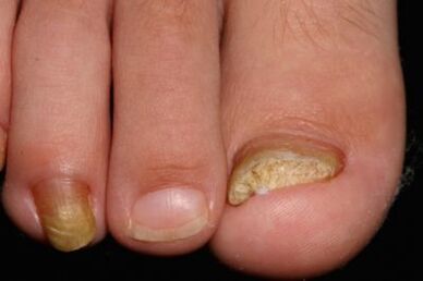 Mycose des ongles sur les jambes