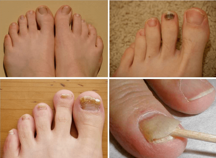 Signes de champignons à ongles