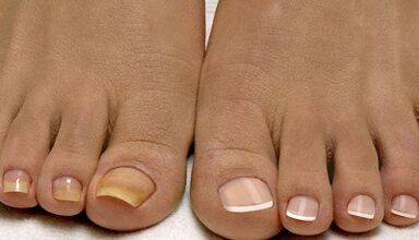 Les causes de l'apparition du champignon sur les ongles