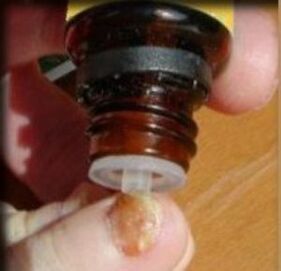 Application de gouttes sur un ongle atteint de champignon