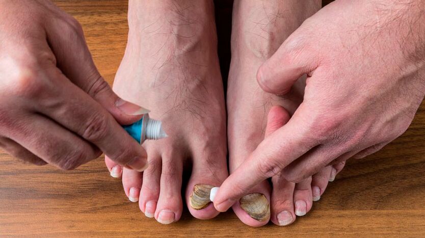 Appliquer une crème antifongique sur les ongles des pieds pour traiter l'onychomycose